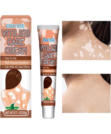  Hongjingda Skin lightening cream for vitiligo - 20g vitiligo relief cream for white patches on the skin reduces white patches improves epidermal melanocytes Hongjingda - Buy Online on GoSupps.com