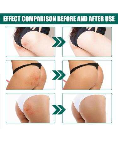 Cr me Nettoyante Acn Fesses et Cuisses Cr me pour les Boutons des Fesses Nettoyage Cr me Dissolvant de Boutons pour les Fesses 100ML 1PC - Buy Online on GoSupps.com