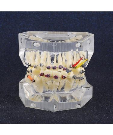 Dental Teeth Model with Metal Brackets - Orthodontic PVC Resin for Dental Schools - Buy Online on GoSupps.com