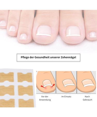 Toenail Patch 50 Pieces Ingrown Toenails Correction Patch Toenail Correction Patch Corrector Pedicure Tools Correction Sticker Toe Nail - Buy Online on GoSupps.com