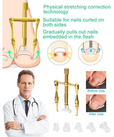 Ingrown Toenail Treatment Tools | Professional Removal Kit & Corrector for At-Home Nail Care - Buy Online on GoSupps.com
