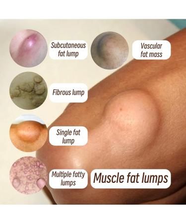 Anti-Lipomes Base de Plantes Lipoma Removal Cream Cr me D' limination Des Lipomes Cr me Naturelle D' limination des Lipomes Cr me Magique pour liminer les Lipomes 20G 1PC - Buy Online on GoSupps.com