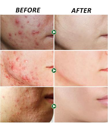 Anti Acne Removal Cream - Acne Treatment Spot and Blackheads Treatment - Day & Night Acne Gel Set - Moisturizing Skincare Fade Acne Spots Oil Control Shrink Pores - For All Skin Types 2x30ml - Buy Online on GoSupps.com