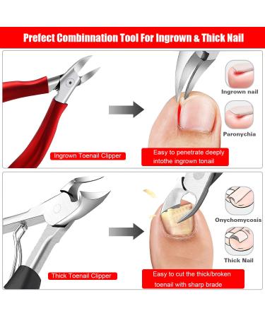 NUNALISA Ingrown Toenail Treatment Kit - Premium Toenail Removal Set with Clippers, File, Pusher, Corrector for Thick & Ingrown Nails - Professional Peticure Tool Included - Buy Online on GoSupps.com