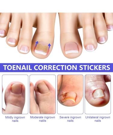 Toen il Correction Sticker 100Pcs: N il Repair P tches Restores Appearance of Discolored or Damaged Nails Foot Care - Buy Online on GoSupps.com