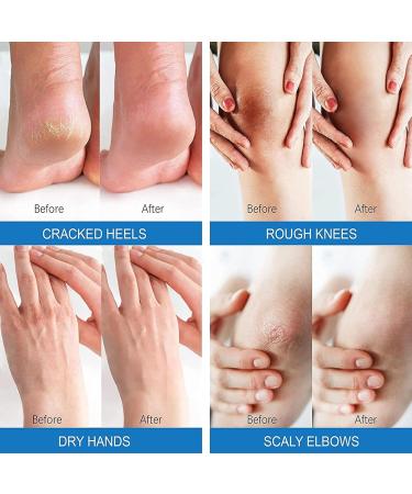 DMQ Foot Cream Ultra Moisturizing 40% Urea Cream Plus Deeply Hydrating Cracked Heel Repair Cream for Callous Removal and Soften Heel Balm Nourishes for Feet Knees Hand - 130g - Buy Online on GoSupps.com