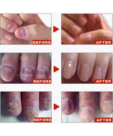 Nail Strengthening Treatment for Damaged Nails Nail Polish Strengthener Nail Hardner Oil Clear Nail Polish Strengthening Nail Growth and Strengthener Extreme Strength Nail Serum Nail Repair Serum - Buy Online on GoSupps.com