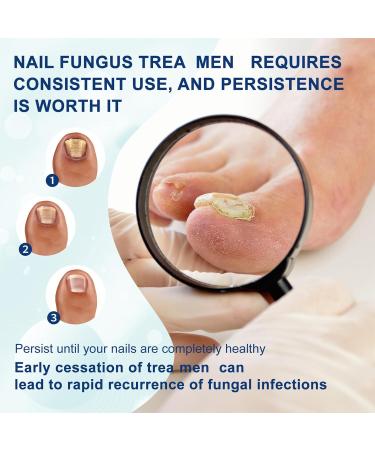 Fungal Nail Serum Pen with Tea Tree Oil and Aloe - Extra Strong Treatment for Toenails and Fingernails - Improve Damaged Nails - 1PCS - Buy Online on GoSupps.com