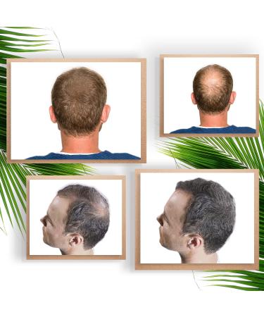  VIDALFORCE Volumizing thickening powder for hair - Baldness hair loss & roots - Natural keratin microfibers. Hair loss concealer | Medium Brown (Fixer + Fibers) | - Buy Online on GoSupps.com