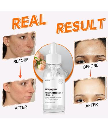 Niacinamide 10% + Zinc 1% Serum, Anti-Aging Niacinamide Serum for Face, 1PCS Moisturizing Facial Serum for All Skin Type, Women Face Skin Care. - Buy Online on GoSupps.com