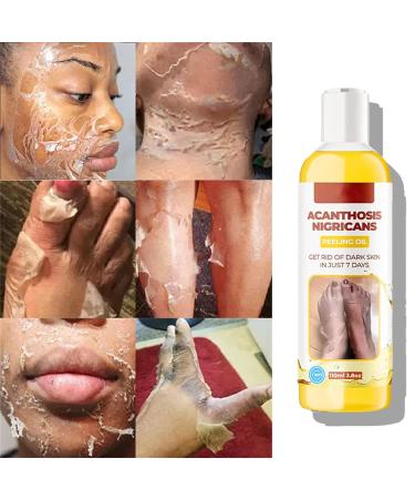 Extra Strong Peeling Oil - Chemical Exfoliant for Face & Body | Reduces Wrinkles Stretch Marks & Dead Skin - Buy Online on GoSupps.com