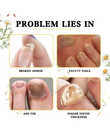 Stylo essence de r cup ration rapide pour ongles de 7 jours pour la croissance des ongles s rum huile fortifiante pour ongles fins et croissance (1 pi ce) 1 pi ce. - Buy Online on GoSupps.com