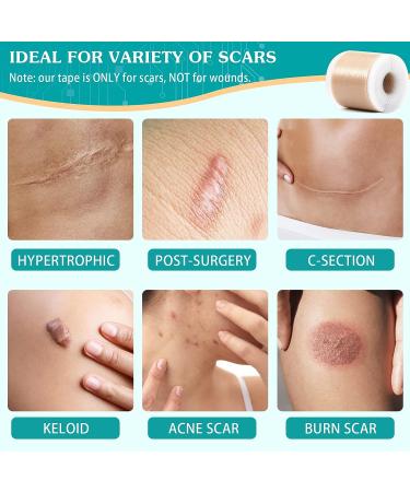 Emibele Silicone Scar Sheets 1.6x120 Roll-3M | Professional Scar Tape for Keloid, Acne, Surgery Scars | Soft & Breathable Silicone Gel Strip for Scar Removal - Buy Online on GoSupps.com