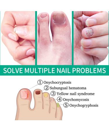 Kerassentials Toenail Treatment Oil - Repair Damaged and Discolored Nails - Buy Online on GoSupps.com
