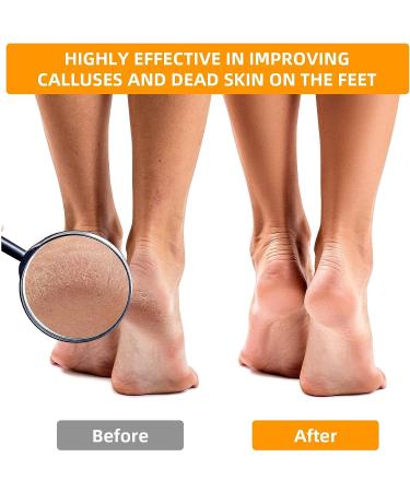 12 PCS Stainless Steel Foot Grater Set - Professional Callus Remover for Feet - Buy Online on GoSupps.com