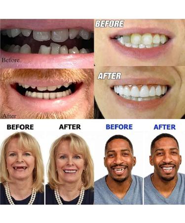 Shop Hfdhd Dentures Pebble Gel - Natural Tones Smile Perfect Veneers | Instant Tooth Repair Set for Men & Women - 7 Pairs Reusable Cosmetic Covers - Buy Online on GoSupps.com