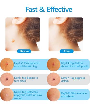 2-IN-1 Micro Skin Tag Tool Kit Quick and Painless Solution for Medium to Large Skin Tags (2mm-7mm) Complete Skin Tag Tool Kit for Fast Results - Buy Online on GoSupps.com