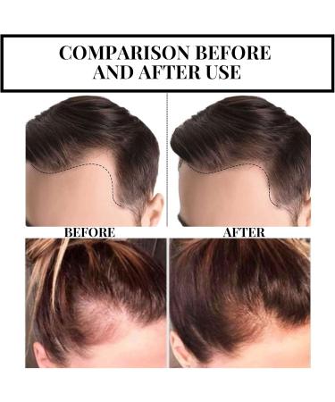 Saksraar Hair Growth Essential Oil Saksraar S rum de Croissance de Cheveux Huile De Repousse des Cheveux Au Gingembre S rum anti-chute de cheveux Perte de Cheveux et Cheveux Effiler Traitement - Buy Online on GoSupps.com