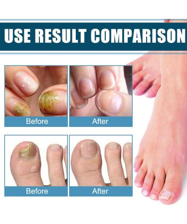 Nail Repair Cream for Damaged Nails | Strengthener for Thin & Cracked Nails | Boost Growth & Strengthen Weak Nails - Buy Online on GoSupps.com