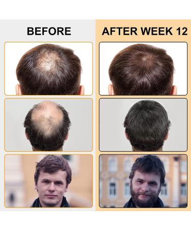 5% Minoxidil Foam Hair Regrowth Treatment for Men & Women - Stops Hair Loss, Promotes Follicle Growth - 2.11fl oz - Buy Online on GoSupps.com