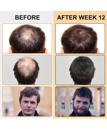 Buy Hair Growth Foam for Men & Women | With Biotin & Capilia Longa | Effective Hair Regrowth Treatment for Thicker Stronger Hair | Stop Hair Thinning - Buy Online on GoSupps.com