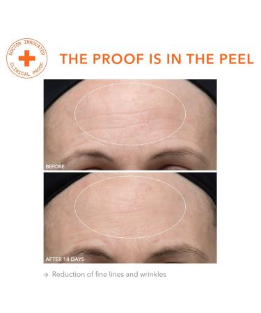 Dr. Dennis Gross Ultra Gentle Daily Peel for Dehydrated or Sensitive Skin - 5 Treatments - Buy Online on GoSupps.com