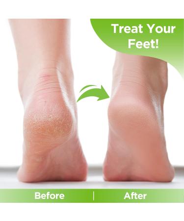 Tea Tree Foot Soak Salts for Foot Recovery - Epsom Salt Bath Soak for Dry Feet - Athletes Foot Soak - 2 Pack, 1lb Each - Buy Online on GoSupps.com