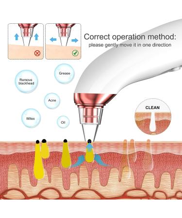 2022 Upgraded Blackhead Remover Pore Vacuum Kit | Facial Pore Cleaner Electric Acne Extractor Tool with 6 Probes | USB Rechargeable | For Women & Men | Suitable for Oil, Dry, and Mixed Skin - Buy Online on GoSupps.com