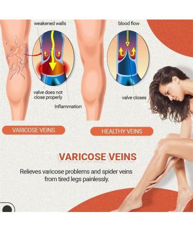 Qqlady Royalaura Medical Quality Compression Stockings for Men & Women - Footless Varicose Vein Support (2 Pairs Size B M) - Buy Online on GoSupps.com
