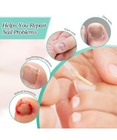 4-Piece Nail Care Pen Set | Nail Repair with Tea Tree Oil Vitamin E & Aloe Vera | Perfect for Healthy Fingernails & Toenails - Buy Online on GoSupps.com