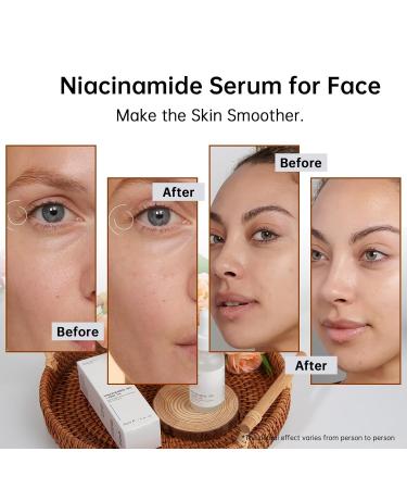Niacinamide 10% + Zinc 1% Serum - Anti-Aging Facial Serum for Acne Pores & Fine Lines - 30ML - International Shipping - Buy Online on GoSupps.com