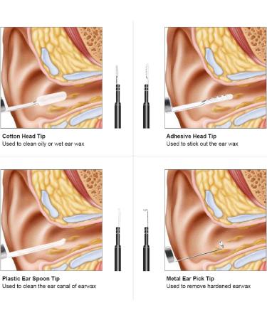 Sanon Otoscope Ear Wax Remover Camera with 6 Dimmable LED - HD Visual Camera for Adults, Kids, and Pets - Compatible with Android Tablet and PC - Buy Online on GoSupps.com