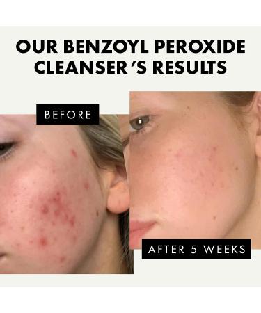 2.5% Benzoyl Peroxide Cleanser with Vitamin E and Aloe Vera - Gentle Brightening Wash for Clearer Skin - Vegan Formula with Niacinamide and Lauric Acid - Buy Online on GoSupps.com
