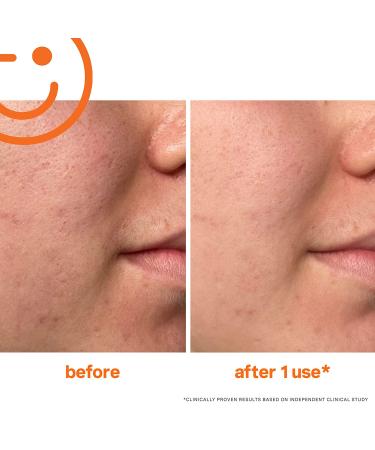 Kate Somerville ExfoliKate Intensive Exfoliating Treatment 0.5 Fl Oz - Salicylic & Lactic Acid Facial Scrub for Texture & Pore Improvement - Buy Online on GoSupps.com