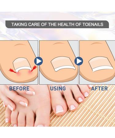 MFCGHXR Nail Care Toenail Correction Patch Set of 124 Includes Patch Nail Stickers File Lifter & Remover Black L - Buy Online on GoSupps.com