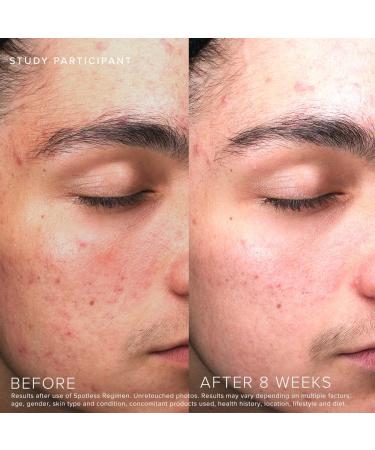 Rodan + Fields Spotless Regimen - Benzoyl Peroxide Face Wash for Sensitive Skin | Effective Skincare Sets for Adults & Teens with Acne | All Skin Types - Buy Online on GoSupps.com