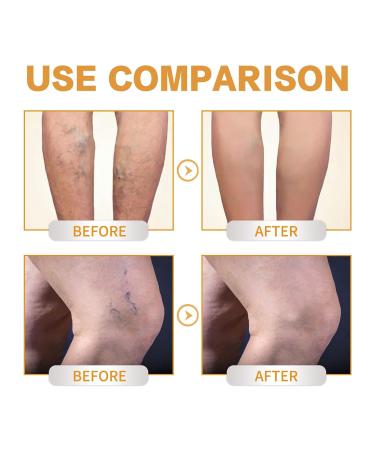 2PCS Varicose Veins Miracle Cream - Vitamin K Formula for Legs & Face | Deeply Nourishing & Moisturizing | All Skin Types - Buy Online on GoSupps.com