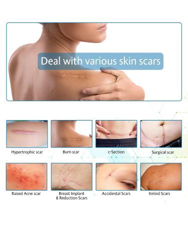 Reusable Silicone Scar Sheets - Medical Grade Tape for Scar Removal - 1 Nude Soft Scar Strips for Surgery, C-section, Burns, Acne, Keloid - Easy-Tear 1.6'' x 60 - Buy Online on GoSupps.com