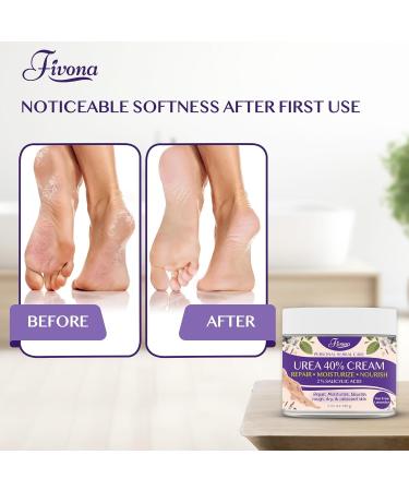 FIVONA 40% Urea Cream with 2% Salicylic Acid - Intensive Foot Lotion for Dry Cracked Heels & Callus Removal | Moisturizing Cream with Tea Tree & Lavender Extracts - Buy Online on GoSupps.com