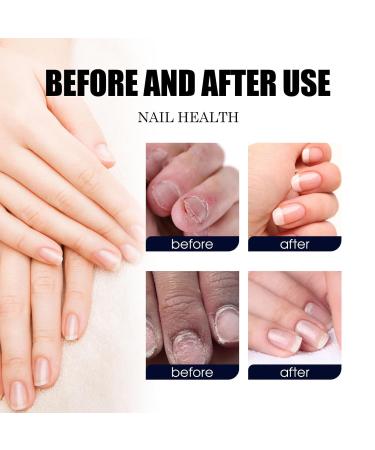 Plant Drops for Nail Care | Oregano & Tea Tree Oil for Toenails | 10 ml - Buy Online on GoSupps.com