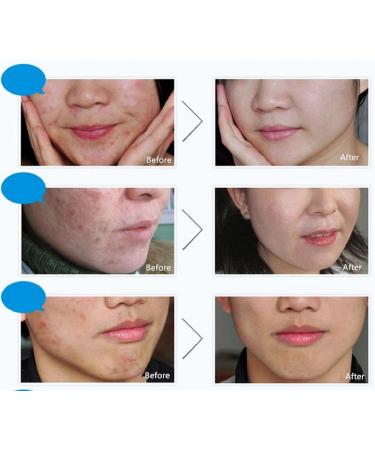 BIOAQUA Face Skin Care Acne Anti-Wrinkle Removal Cream Spots Scar Blemish Marks 30g 1.05 Ounce (Pack of 1) - Buy Online on GoSupps.com