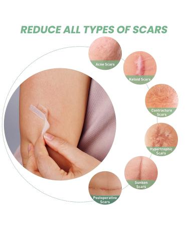 Mebak Clear Silicone Scar Gel Tape Roll (1.6 x 60) - Acne & C-Section Scar Removal Treatment - Reusable Transparent Strips for Keloid Surgery - Scars Treatment Sheets - Buy Online on GoSupps.com