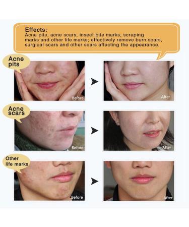 3 Pack TCM Scar Removal Cream - Scar Reducing Treatment for Stretch Marks, Acne Scars, Surgical Scars - 1.1 Ounce (Pack of 3) - Buy Online on GoSupps.com