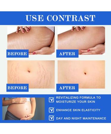 120 g Anti-Stretch Stretch Mark Massage Balm Pregnancy Body Cream Body Cream Stretch Mark Pregnancy Cream for Prevents and Reduces the appearance of Stretch Marks - Buy Online on GoSupps.com