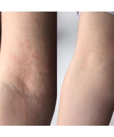 HydraNure Organic Eczema Treatment for Babies - 3.4fl oz/100ml | Soothes, Heals & Protects Skin | Best Remedy for Baby Eczema, Dry Skin & Itchiness - Buy Online on GoSupps.com