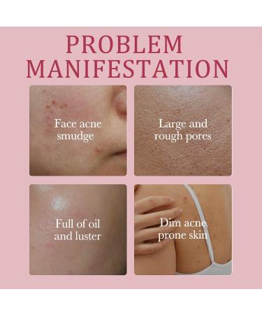 Moisturising Bar Soap for Acne Blackheads Dark Spot - Natural & Organic Body & Hand Soap Bar - Natural Soap for Body Face and Hair - Rose Essential Oil Soap - Body Soap for Soft and Smooth Skin - Buy Online on GoSupps.com
