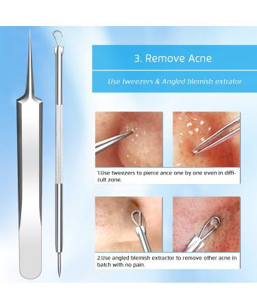 Blackhead and Acne Removal Kit with Tweezers - Pimple Comedone Extractor Tool for Face, Forehead, and Nose - Blemish and Whitehead Treatment - Buy Online on GoSupps.com