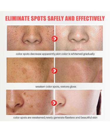 Dark Spot Remover for Face Niacinamide Acid & Arbutin Spot Cream Dark Spot Correcting Glow Serum Age Spot Remover for Face Freckle Removal Cream to Even Skin Tone Fade Melanin - Buy Online on GoSupps.com