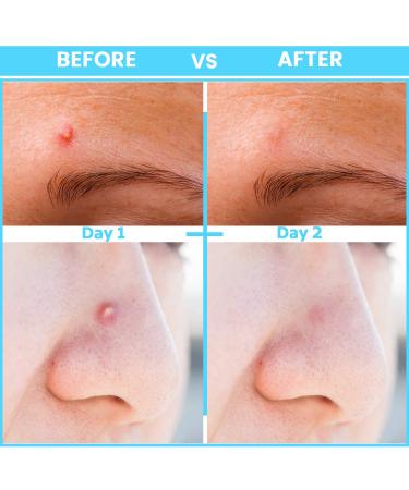 Acne Pimple Micropoint Patches - 18 Count (2 Packs) | Best Spot Treatment for Inflamed Cystic Acne and Hormonal Breakouts - Buy Online on GoSupps.com