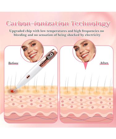 Skin Tag Removal Pen Weslery Skin Tag Remover Pen Laser's Pen with 9 Strength Levels & LED Light Mole Remover Pen USB Rechargeable Spot Pen Plasma Pen for Face Body Wart Freckle Nevus Spot Age Spots - Buy Online on GoSupps.com